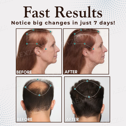Best Seller 🎉limited-time discount | Acezozla® Hair Regrowth Capsules 💖Revive Follicles, Boost Hair Volume